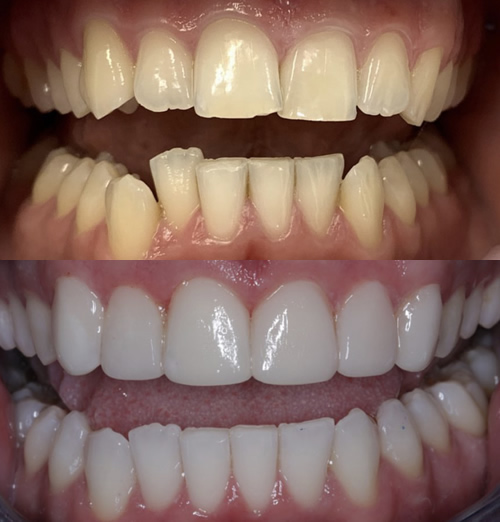 Invisalign Bonding and Whitening in Huddersfield