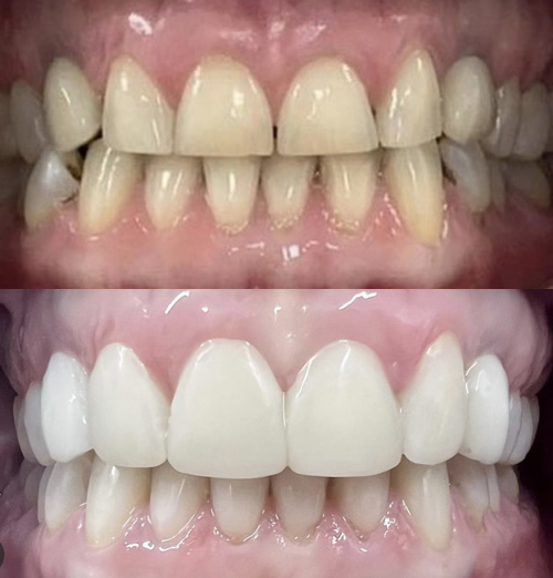 Invisalign Bonding and Whitening in Huddersfield