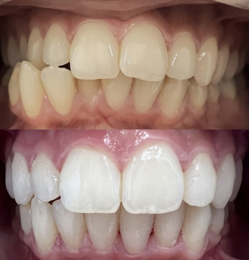 Invisalign Bonding and Whitening in Huddersfield