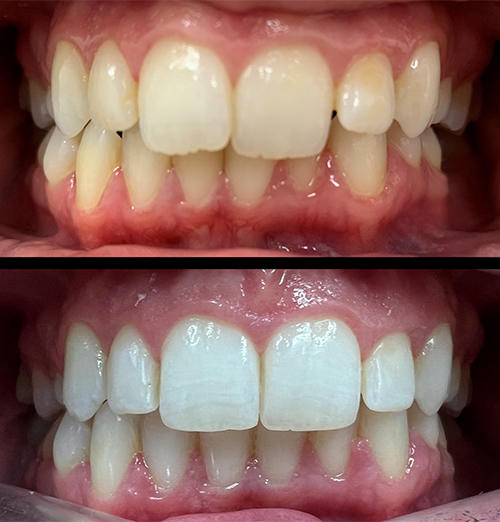 Emma Invisalign in Huddersfield