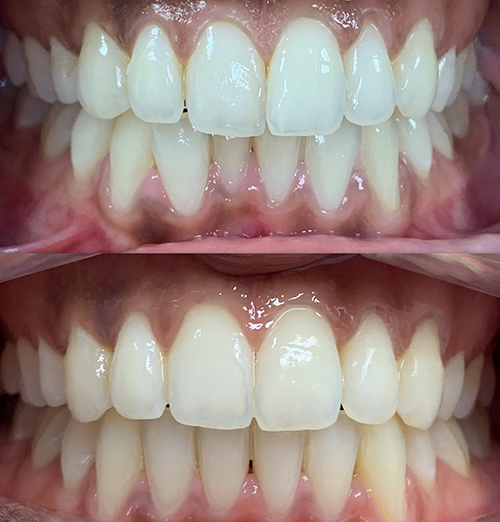 Mehvish Invisalign in Huddersfield
